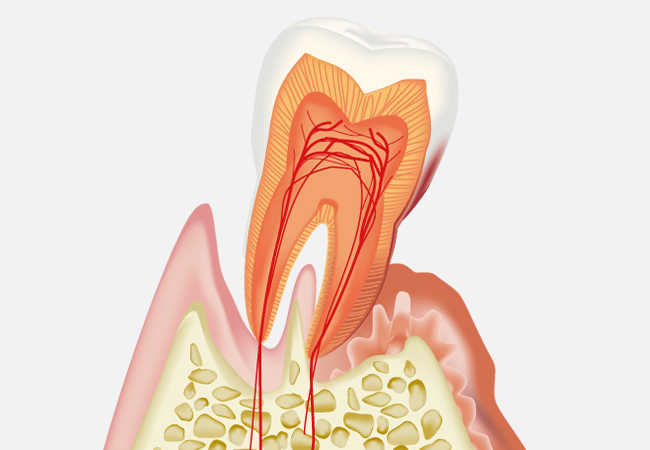 歯周病とは